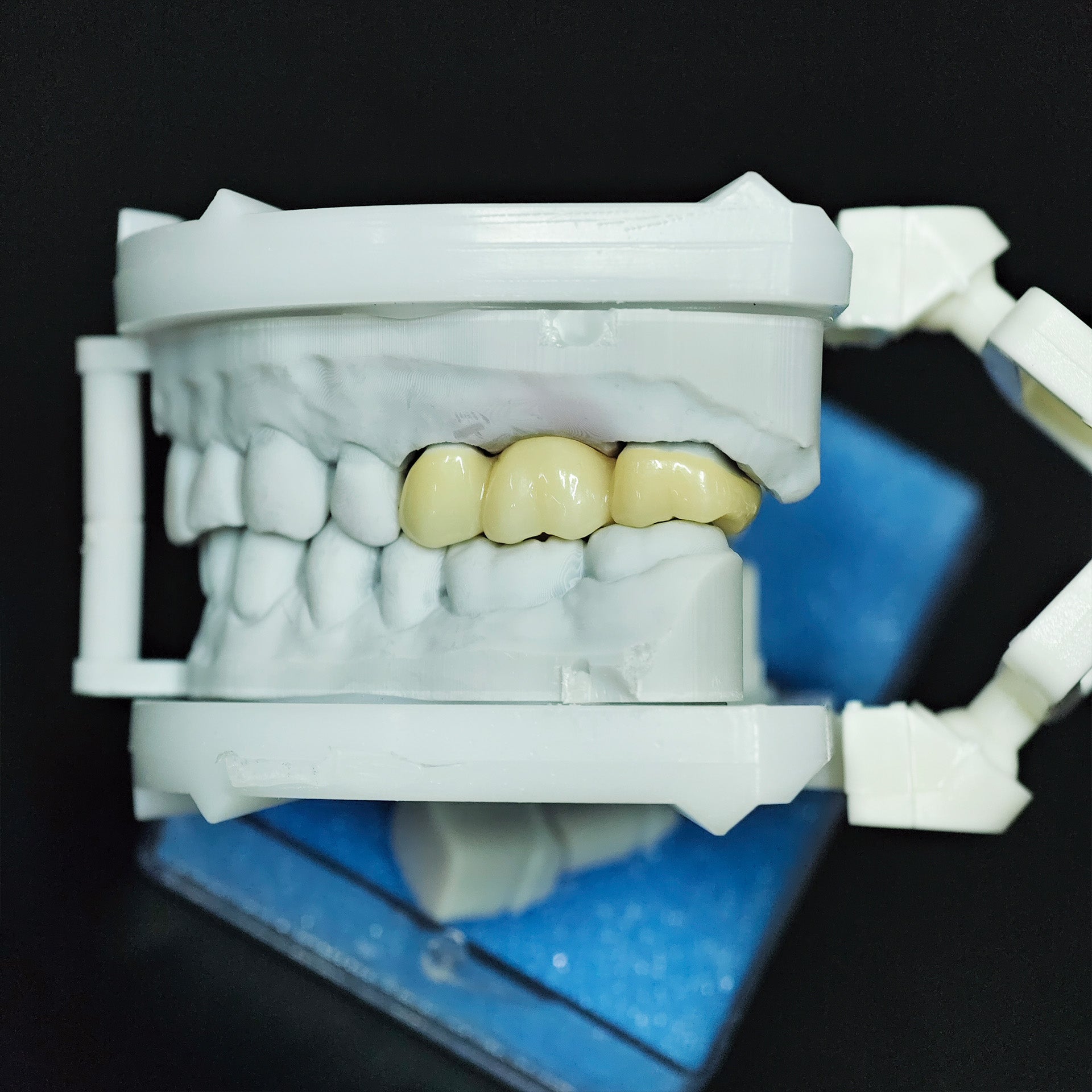 High - Strength Zirconia Bridge
