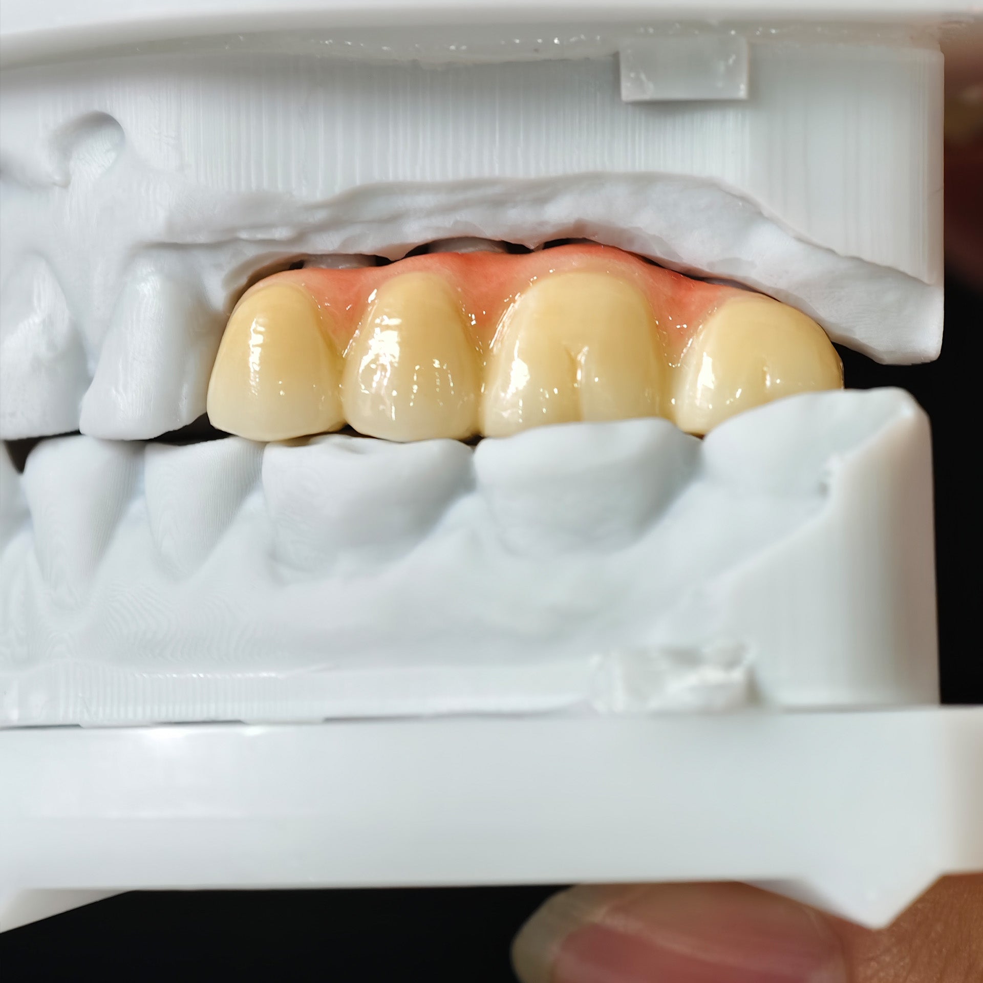 High - Strength Zirconia Bridge