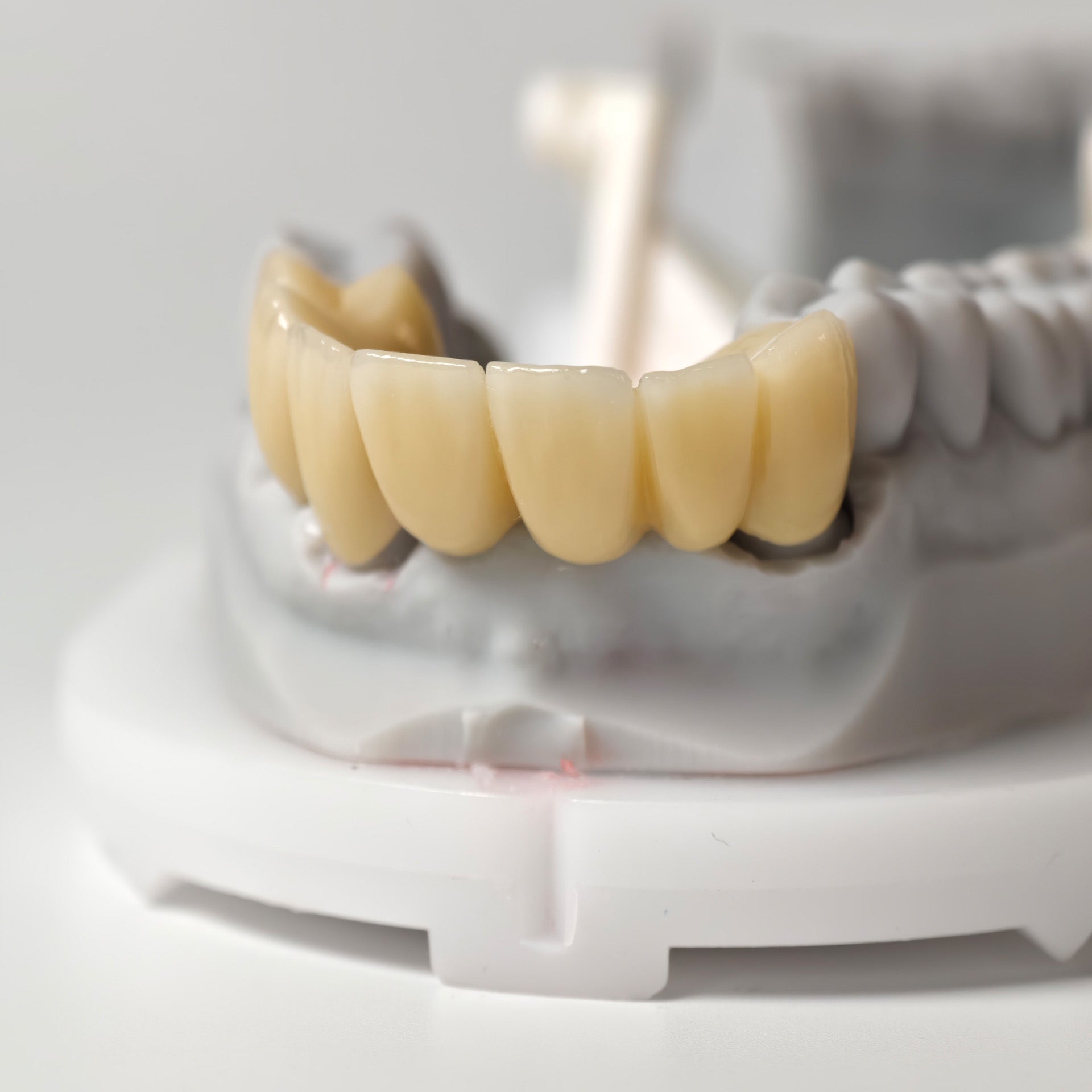 High - Strength Zirconia Bridge