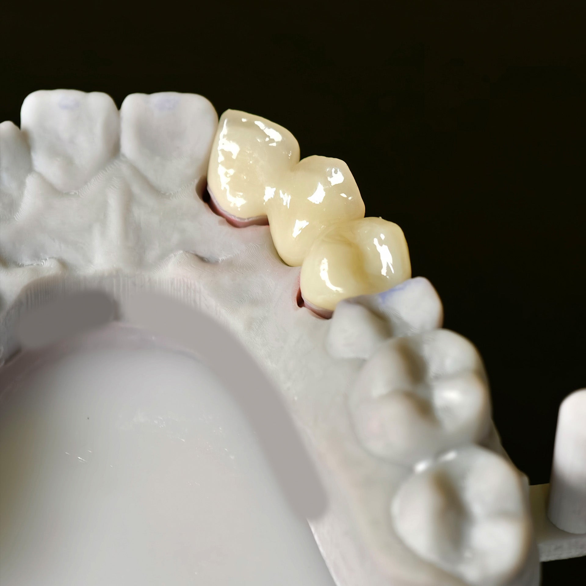 High - Strength Zirconia Bridge