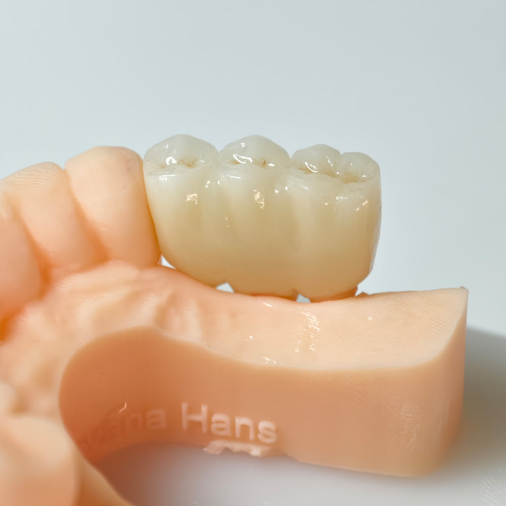High - Strength Zirconia Bridge