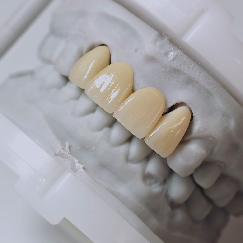 High - Strength Zirconia Bridge