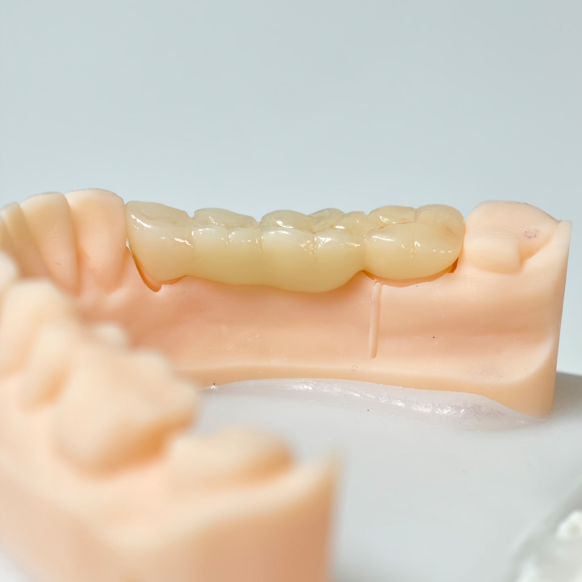 High - Strength Zirconia Bridge