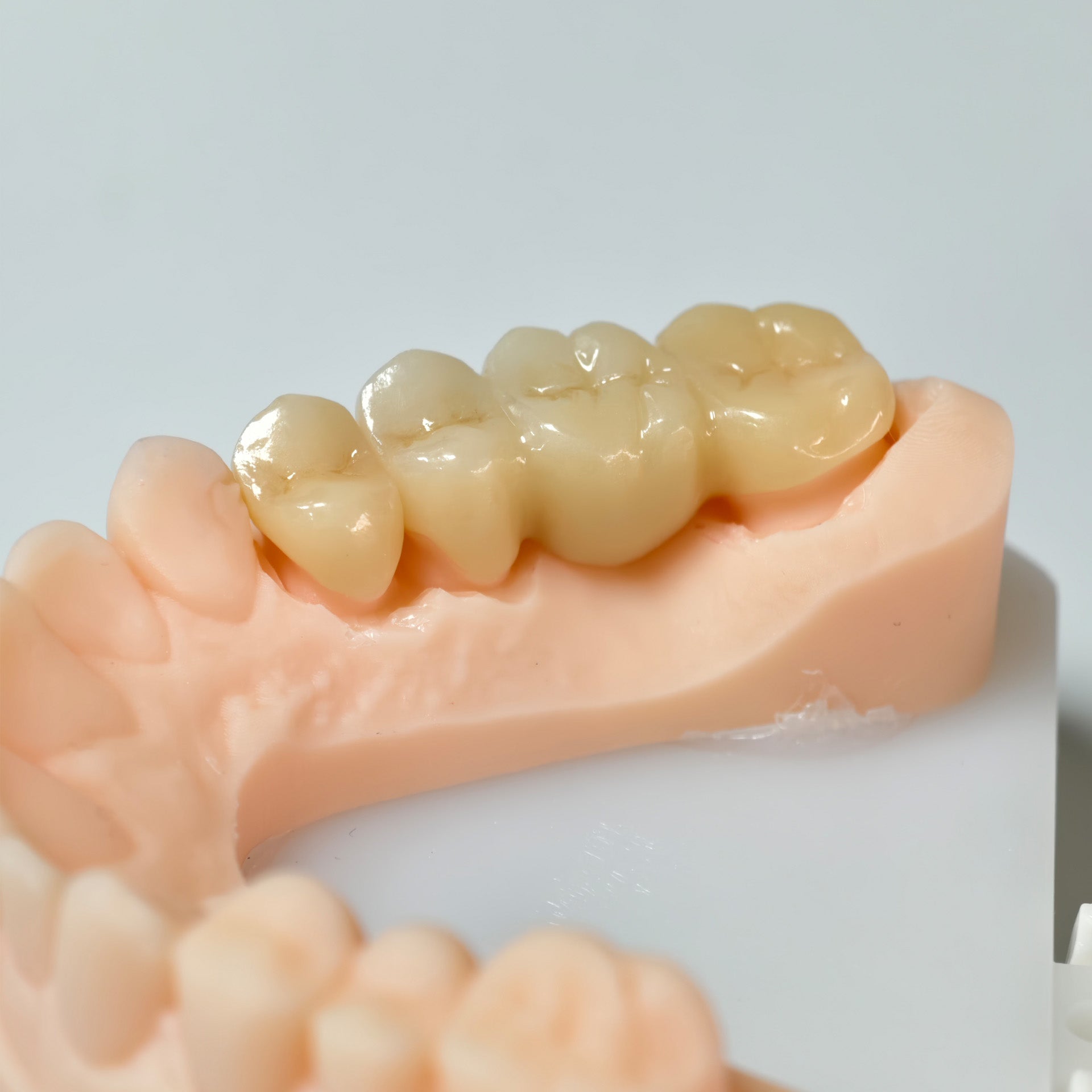 High - Strength Zirconia Bridge And Crown