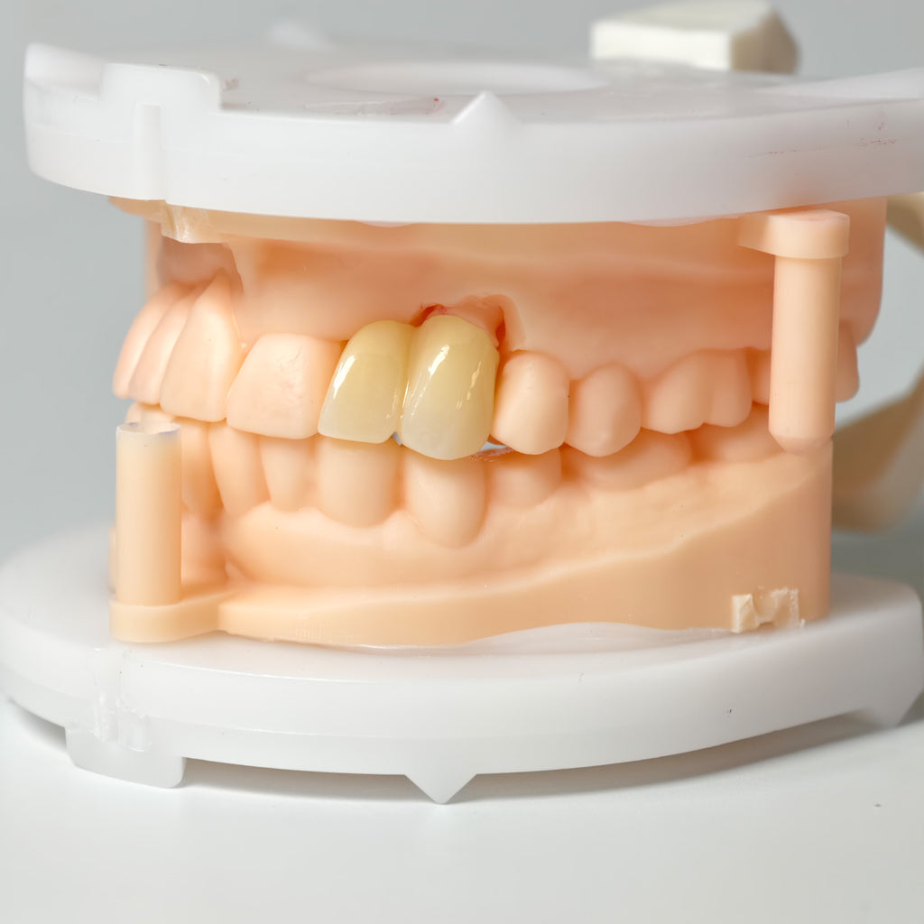 High - Strength Zirconia Crown