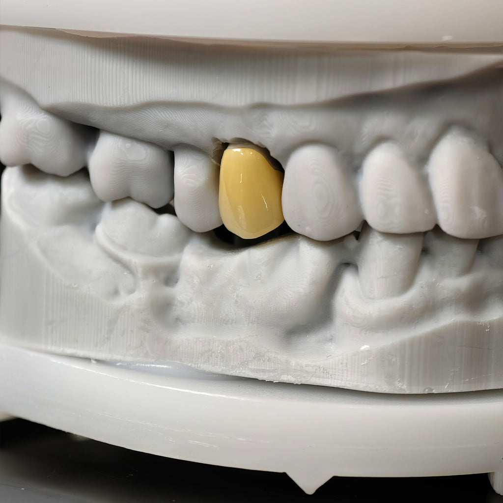 High - Strength Zirconia Crowns
