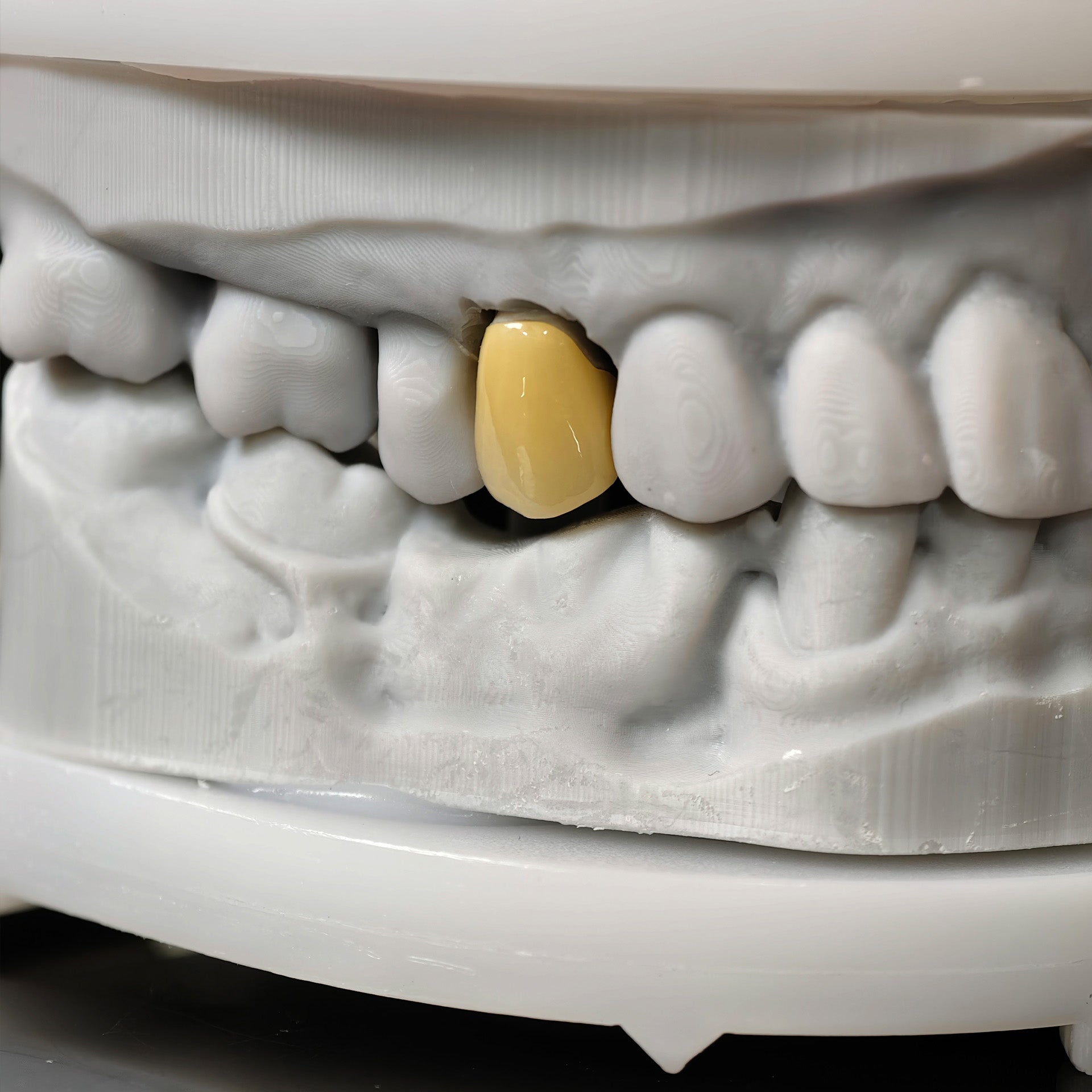 High - Strength Zirconia Crowns