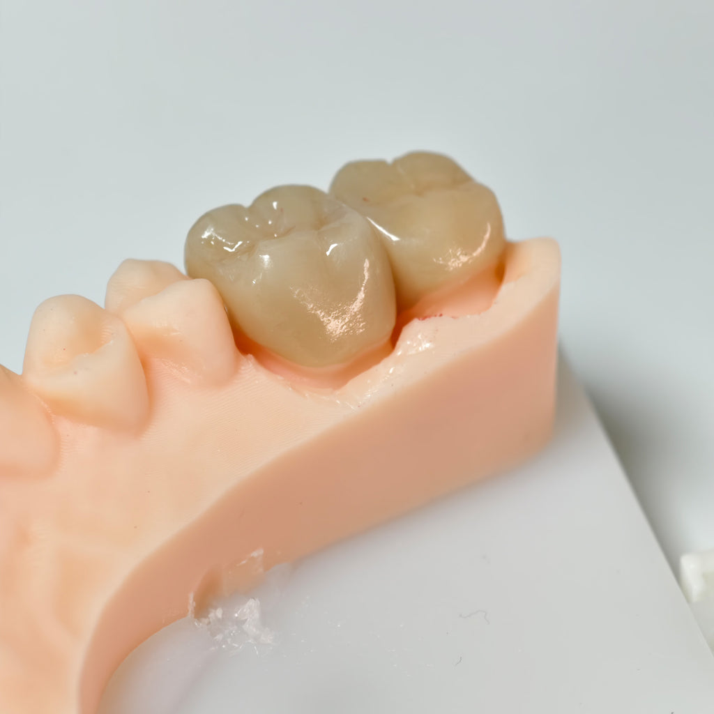 High - Strength Zirconia Crowns