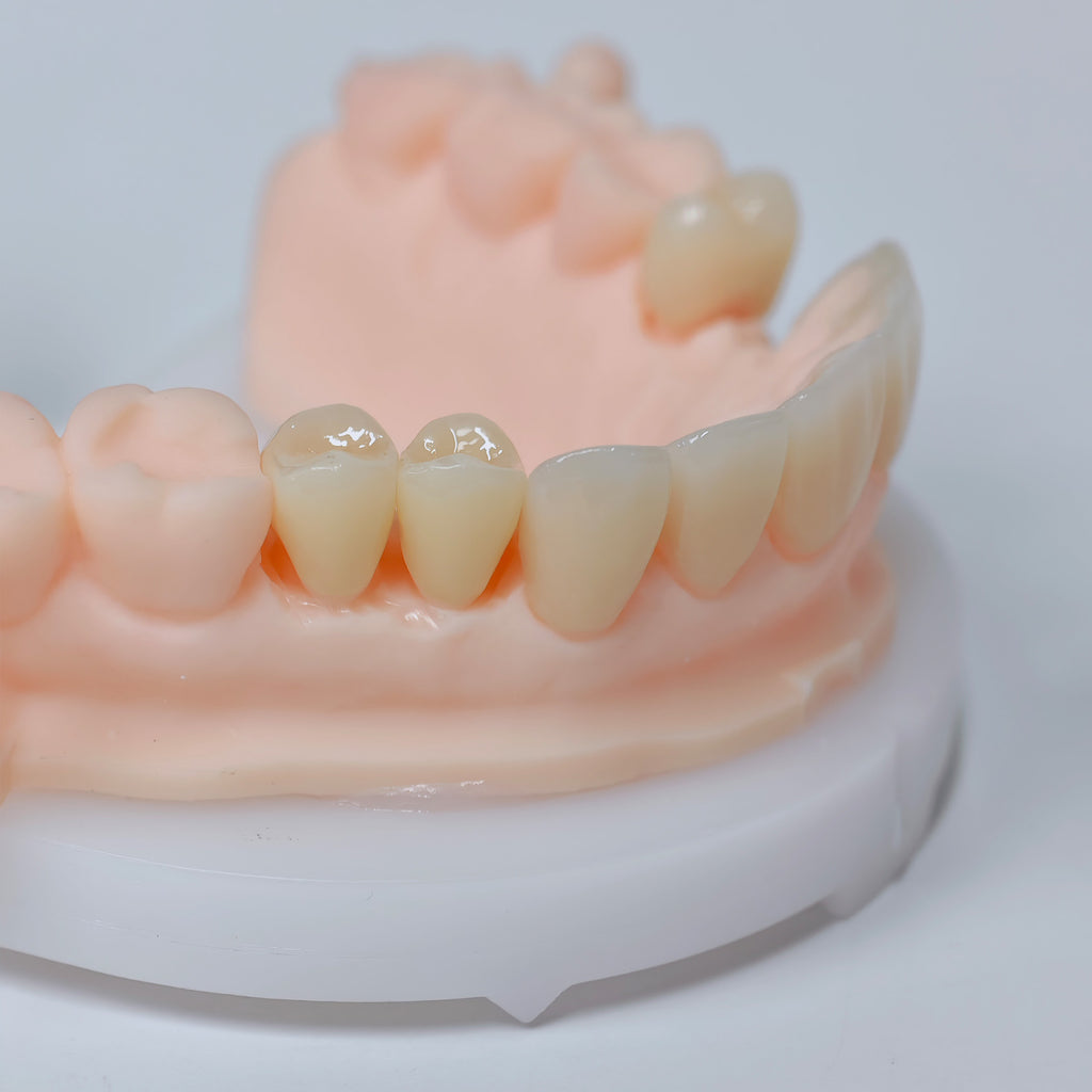 High - Strength Zirconia Crowns And Ceramic Veneers