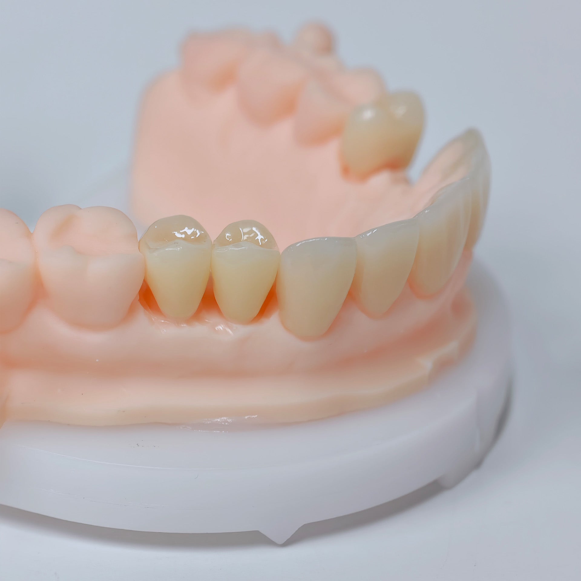 High - Strength Zirconia Crowns And Ceramic Veneers