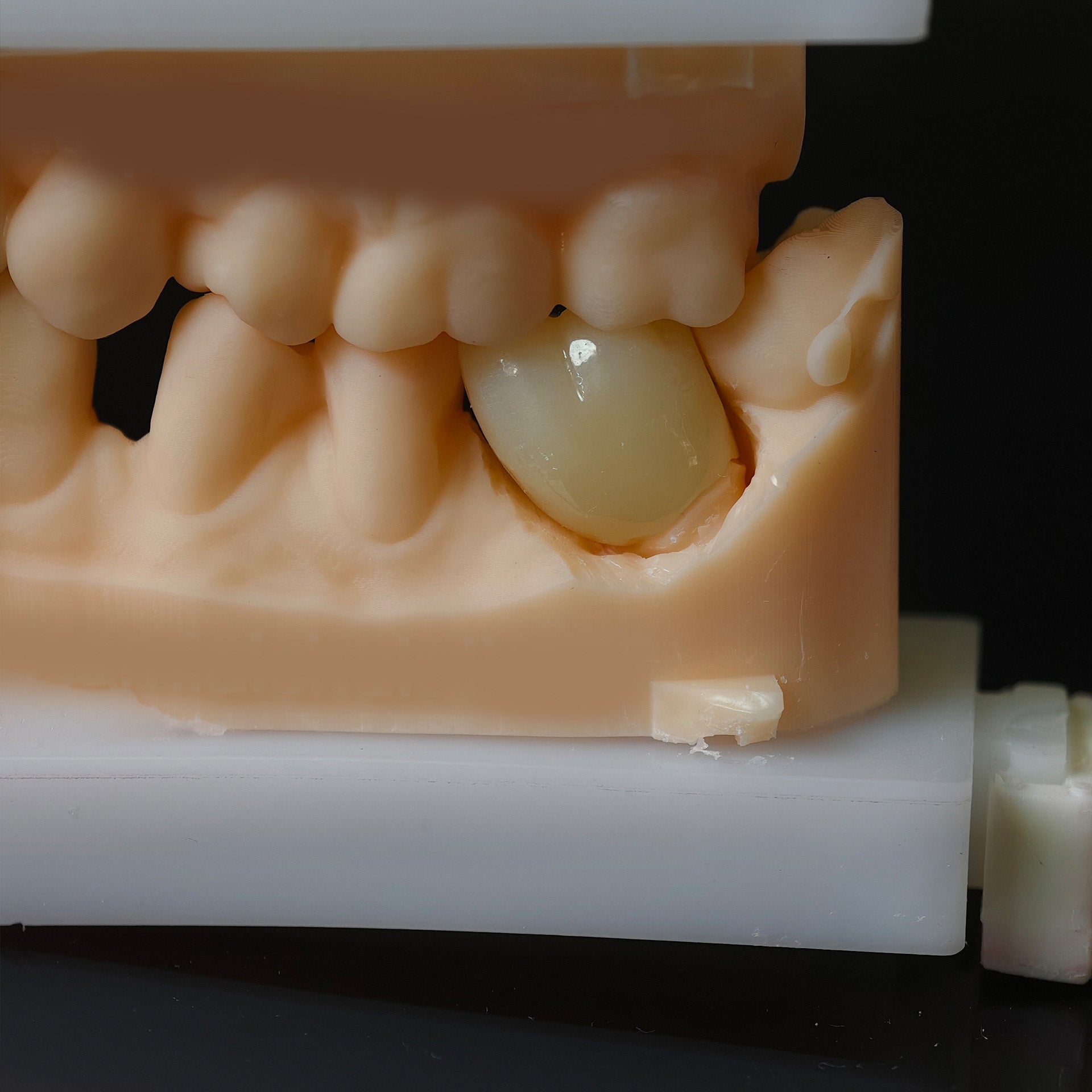 High - Strength Zirconia Dental Crown