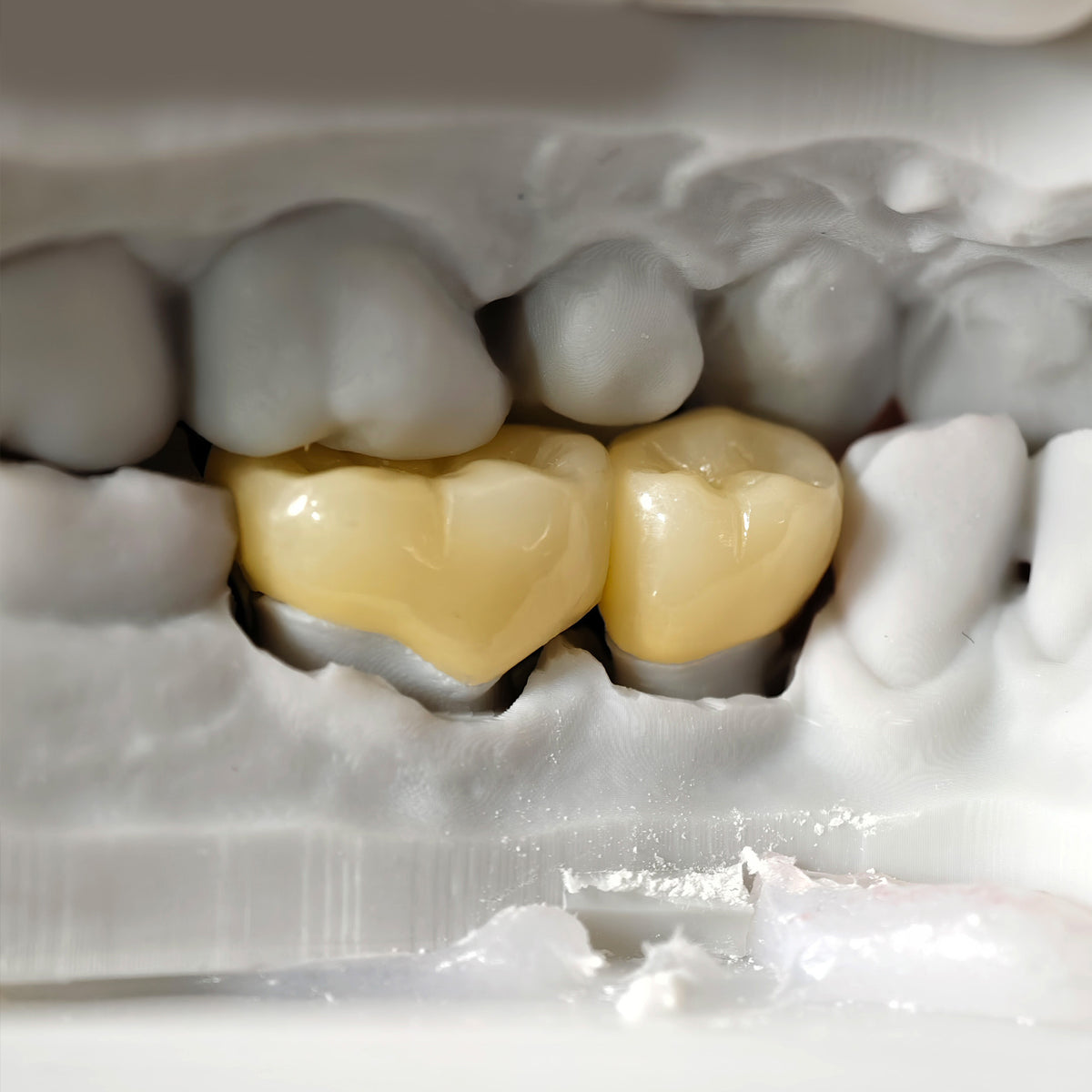 High - Strength Zirconia Dental Crowns