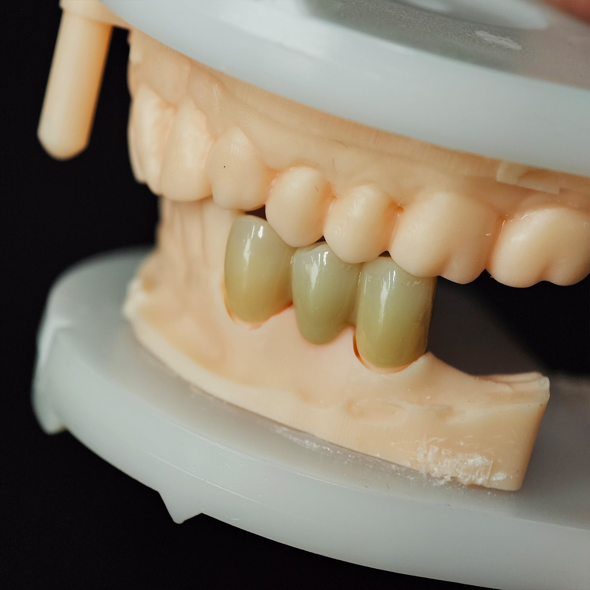 High - Strength Zirconia Bridge