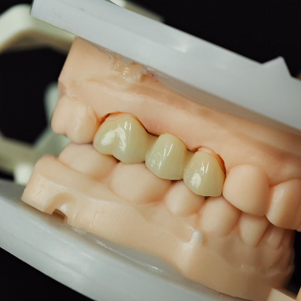 High - Strength Zirconia Bridge