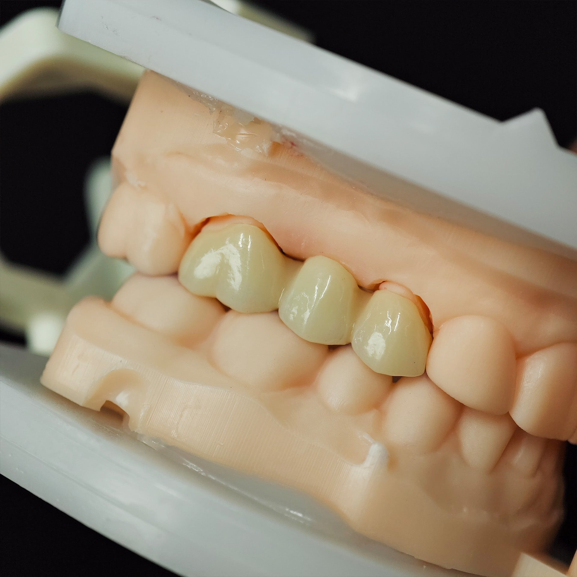 High - Strength Zirconia Bridge