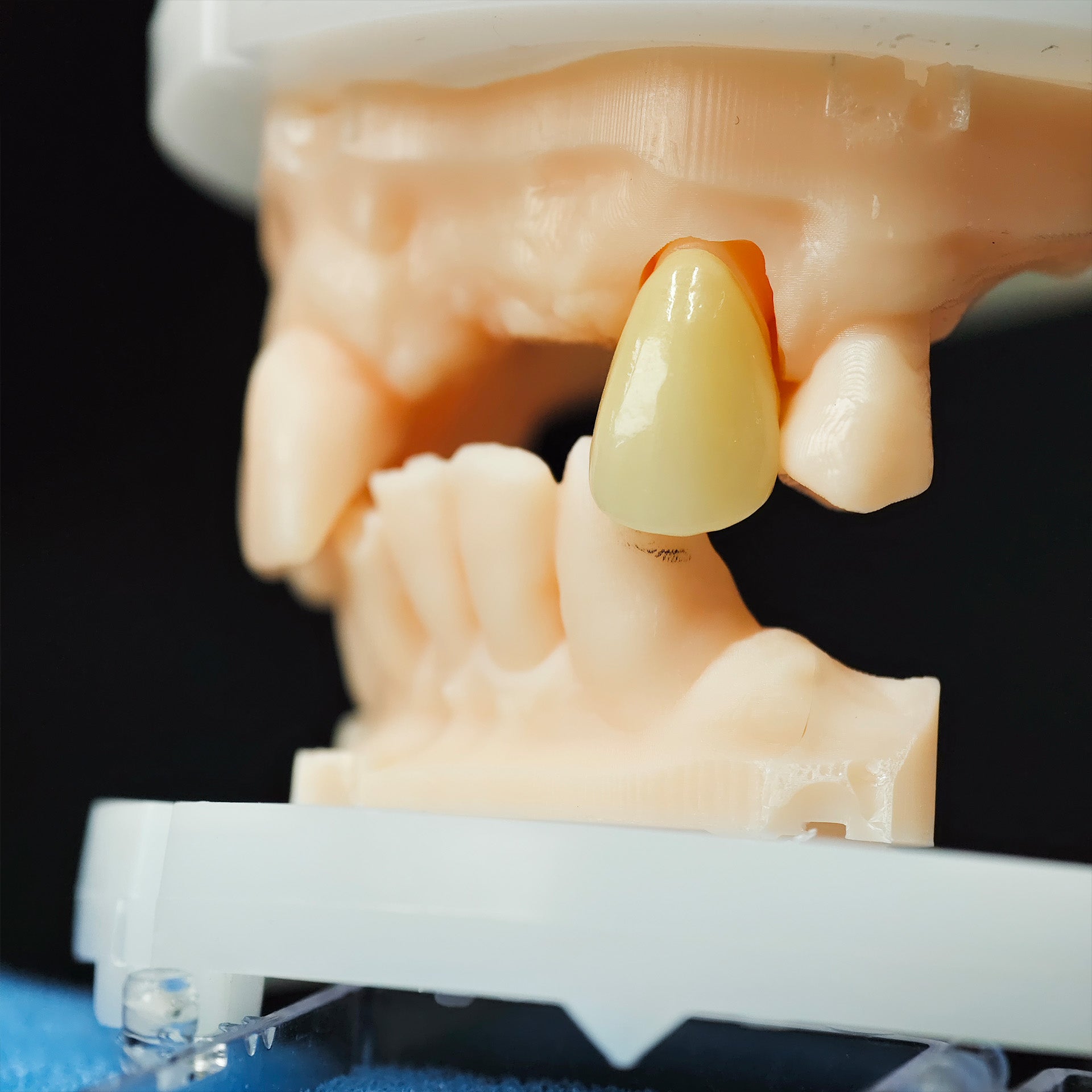 High - Strength Zirconia Crown