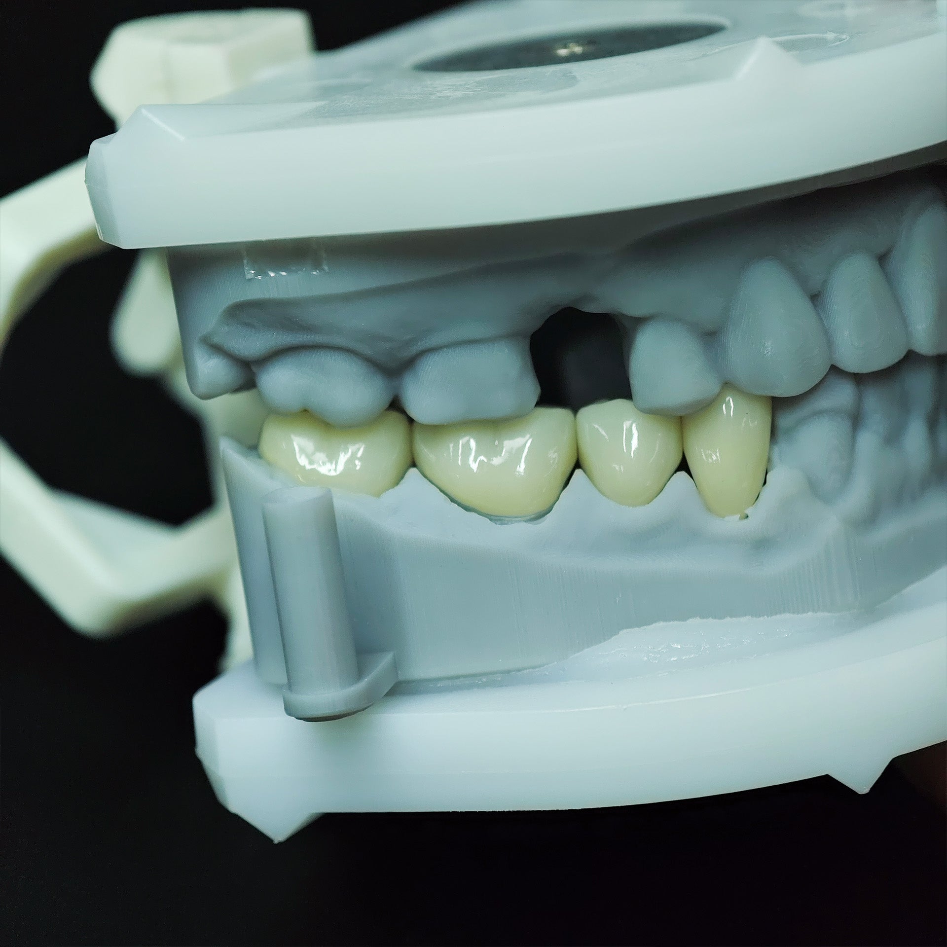 High - Strength Zirconia Crowns