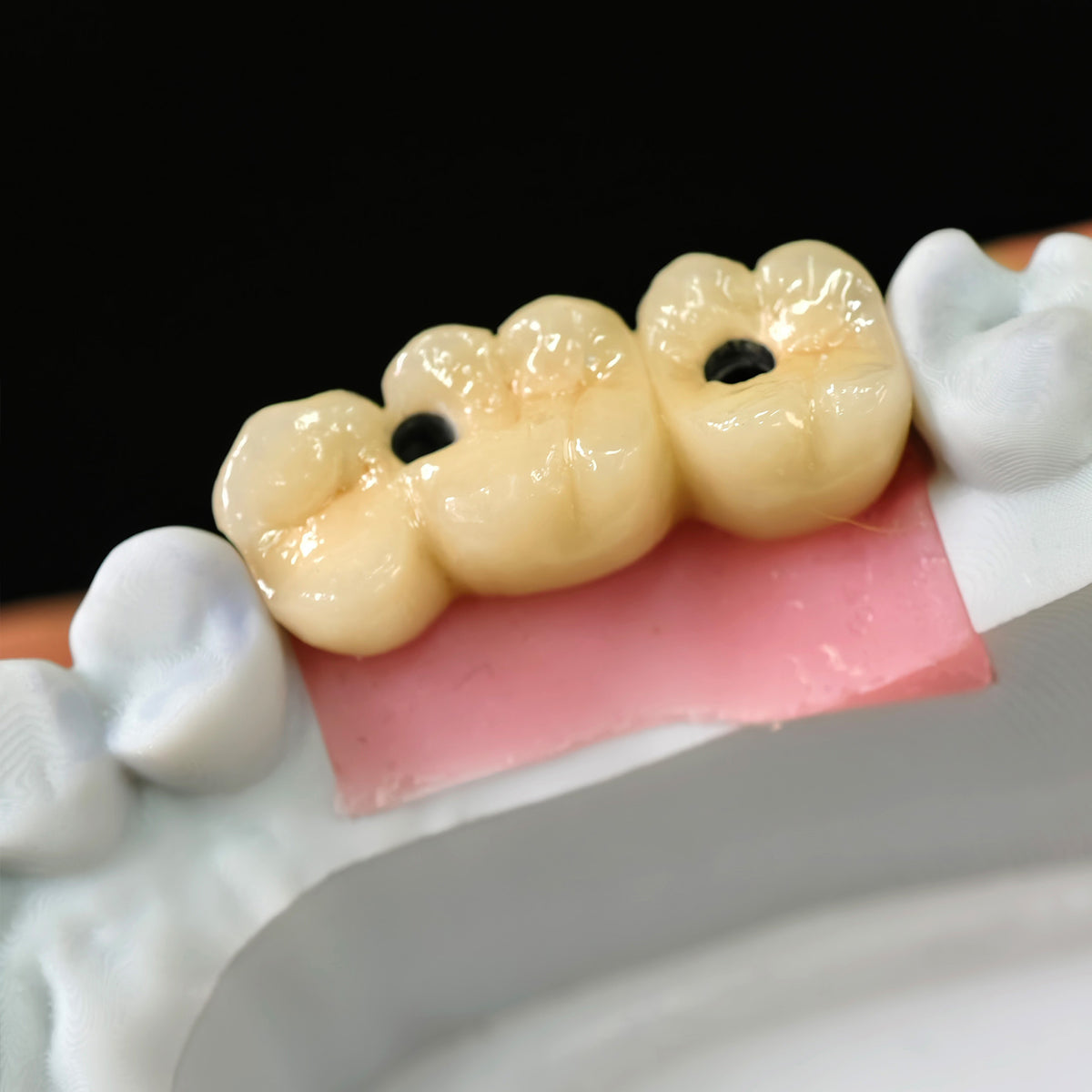 Implant-supported Co - Cr PFM Dental Bridge