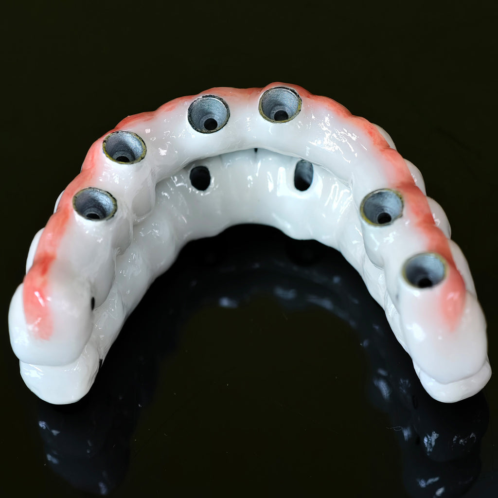 Implant-supported Co - Cr PFM Dental Bridge