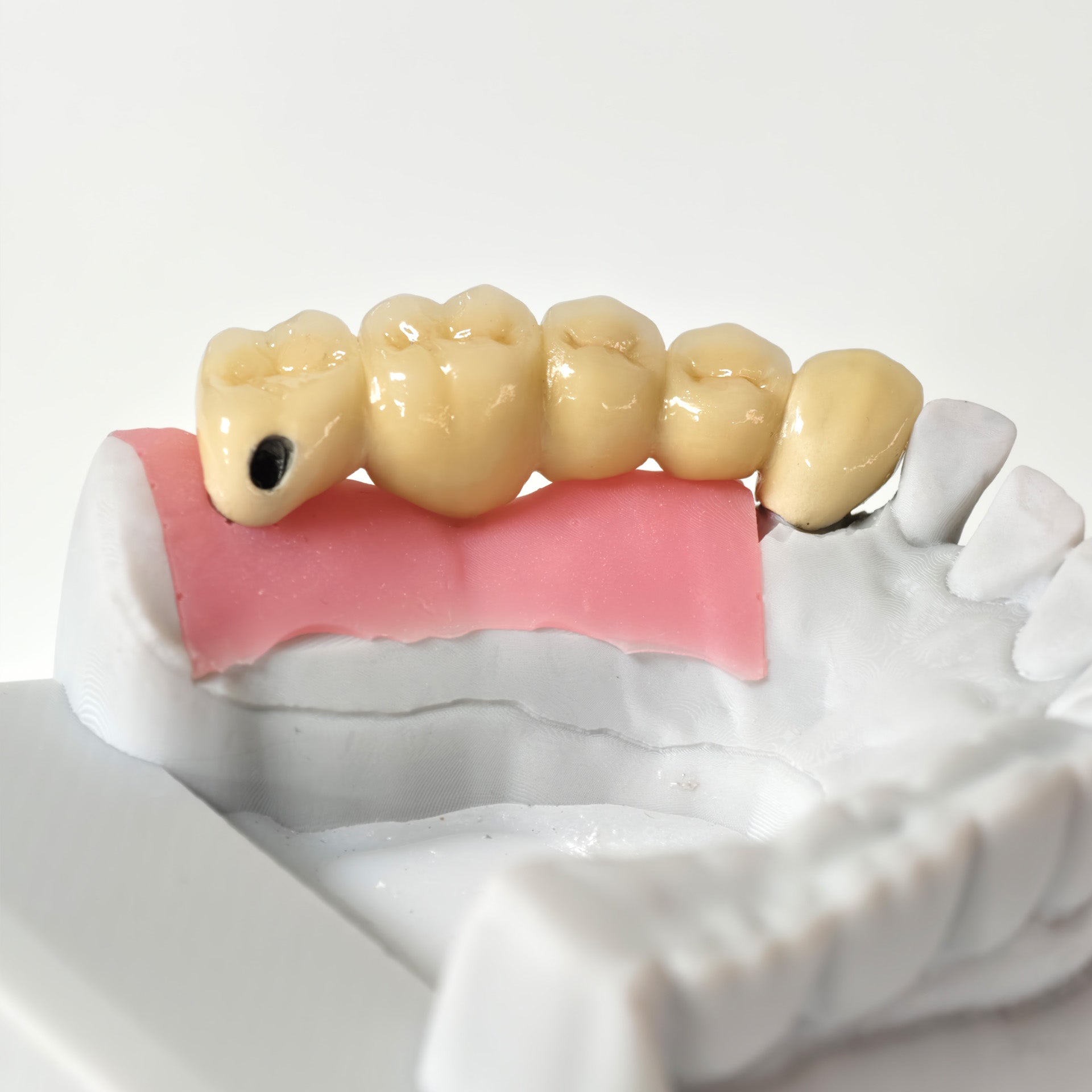Implant-Supported PFM Single Bridge