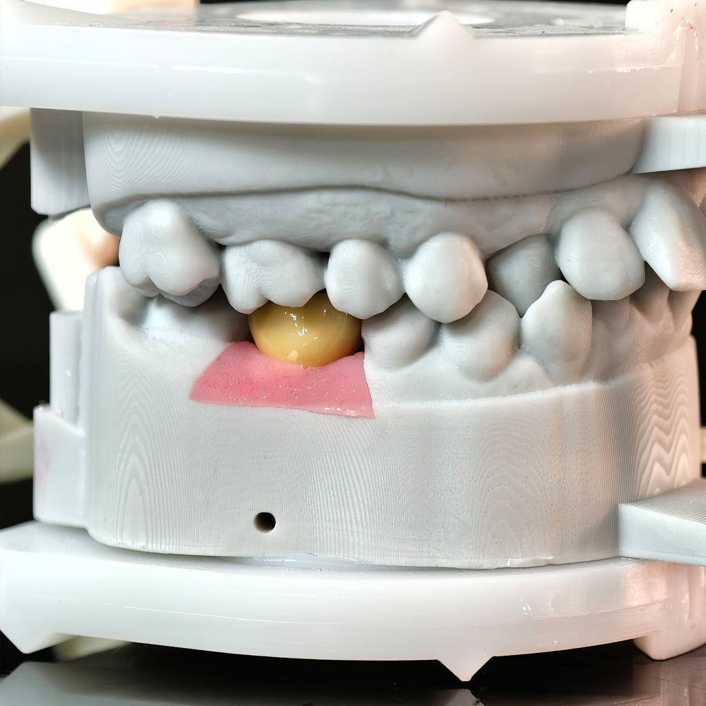 Implant-Supported PFM Single Crown