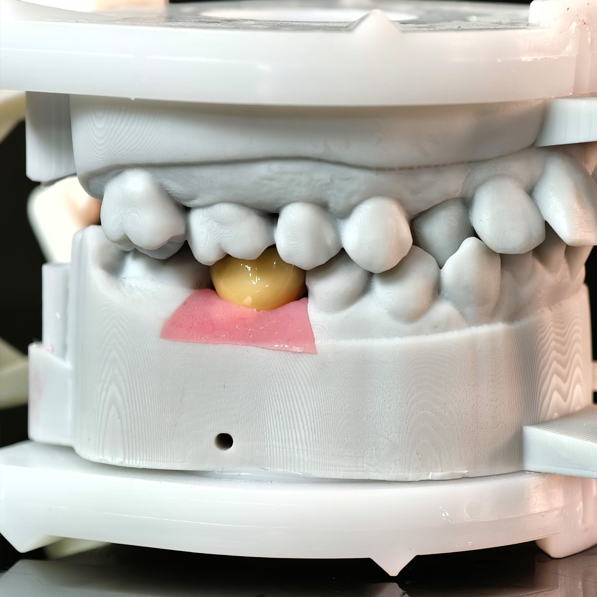 Implant-Supported PFM Single Crown