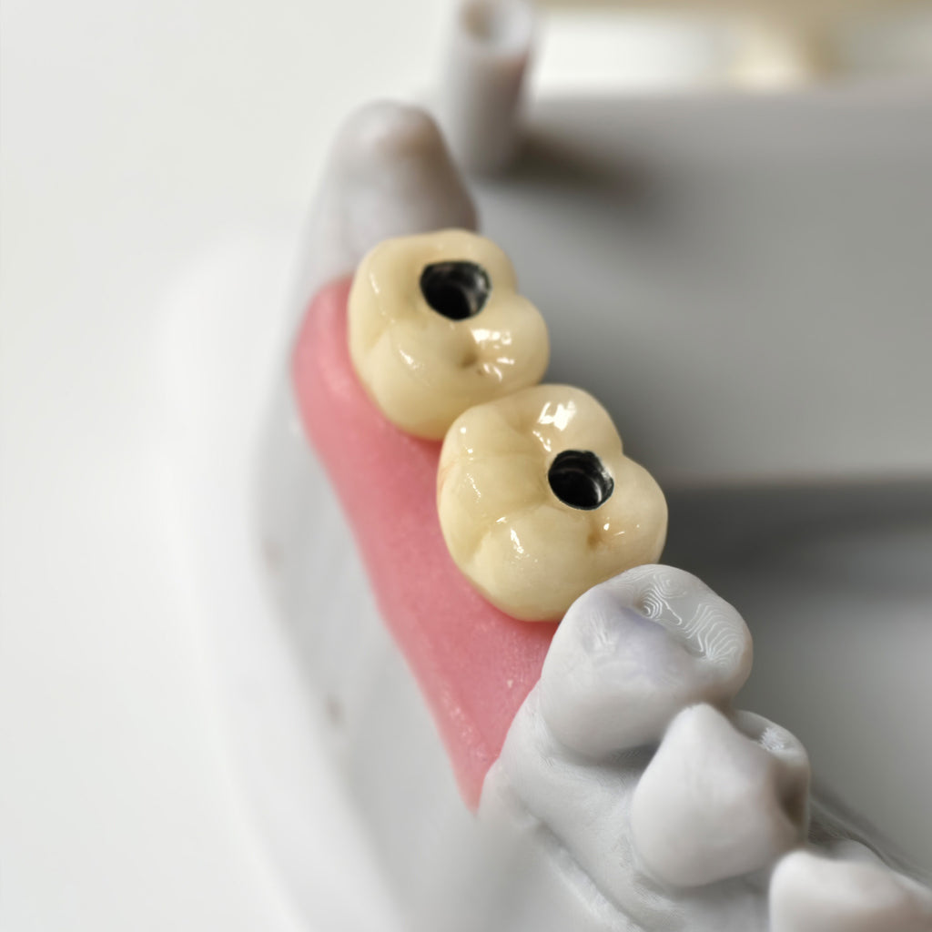 Implant-Supported PFM Single Crowns
