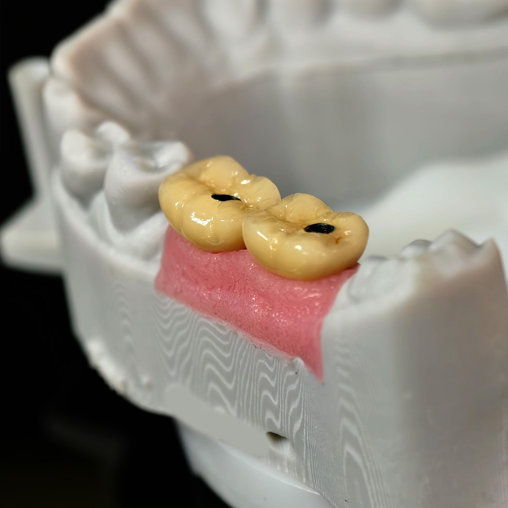 Implant-Supported PFM Single Crowns