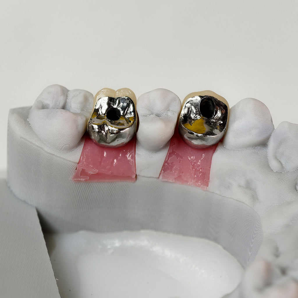 Implant-Supported PFM Single Crowns With Metal