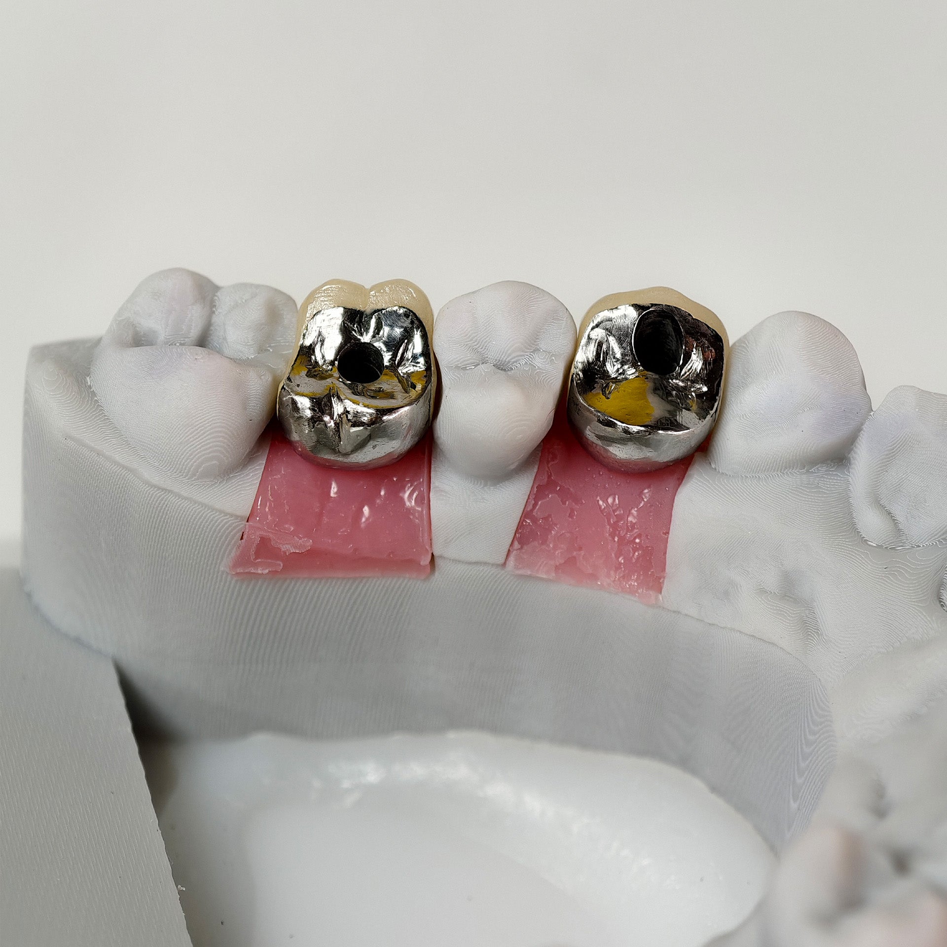 Implant-Supported PFM Single Crowns With Metal