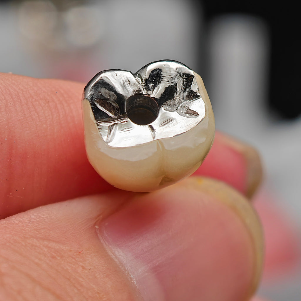 Implant-Supported PFM Single Crown With Metal