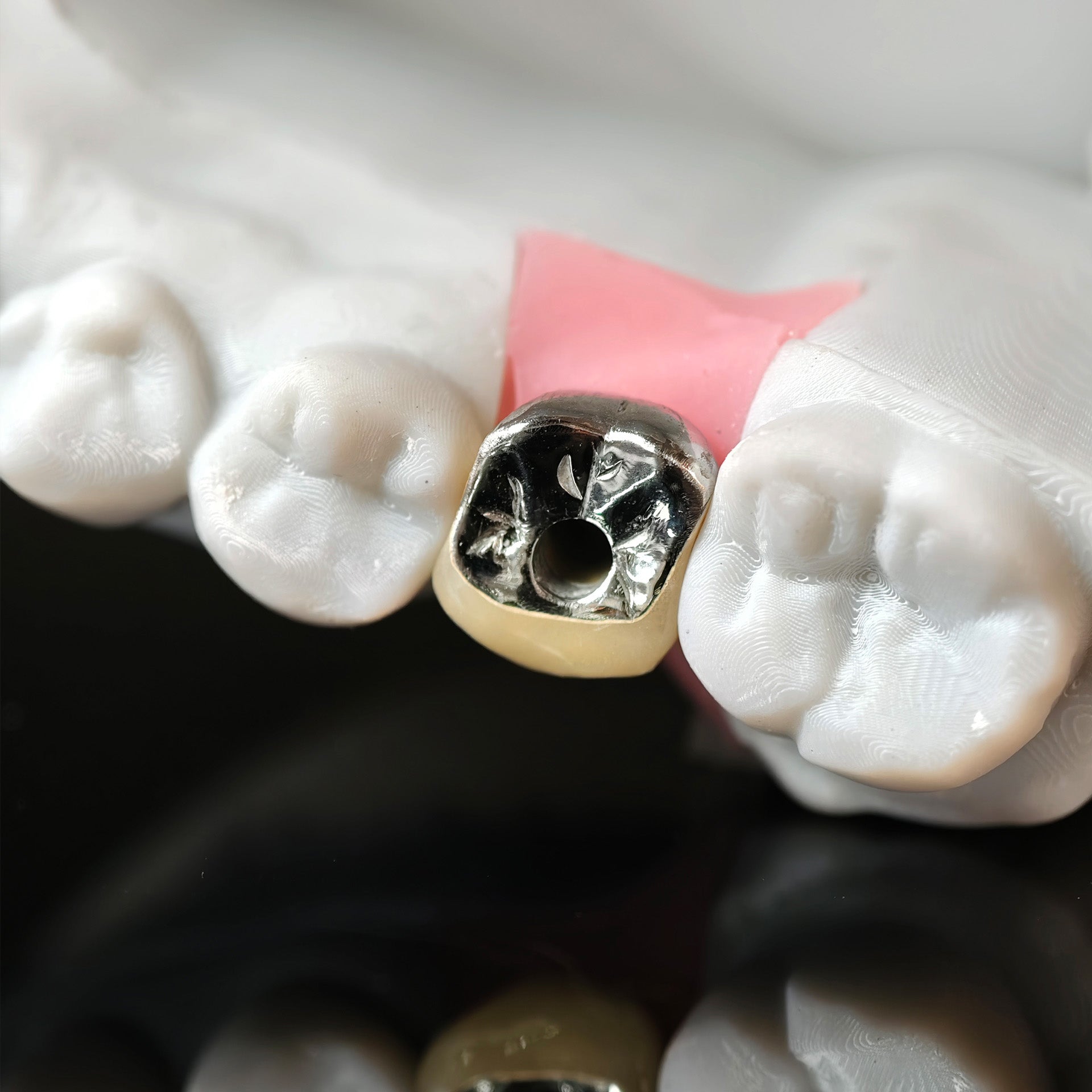 Implant-Supported PFM Single Crown With Metal
