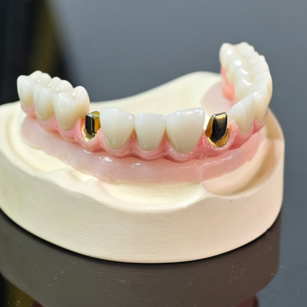 Malo Bridge With Gold-Plated Grade 5 Pure Titanium Malo Bridge