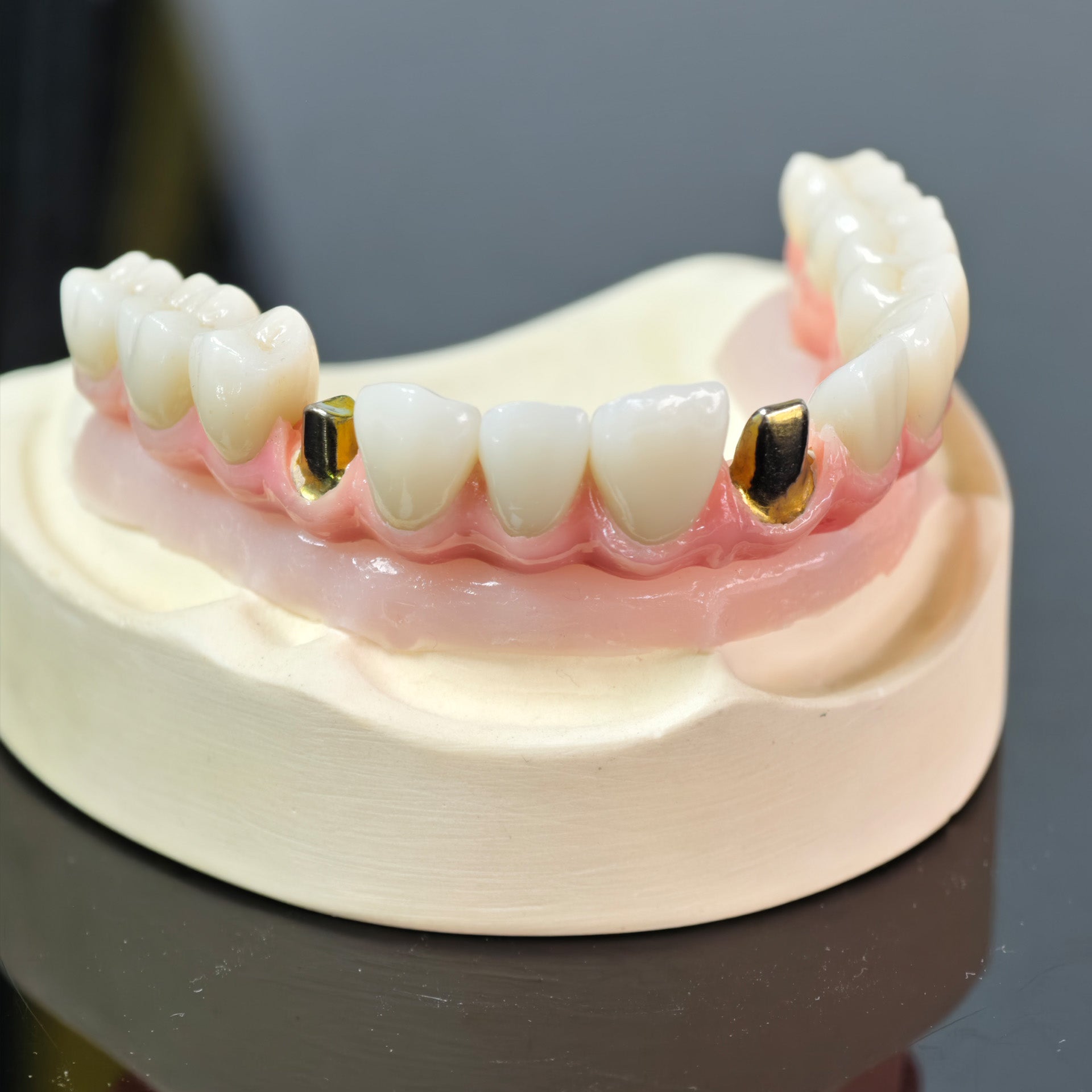 Malo Bridge With Gold-Plated Grade 5 Pure Titanium Malo Bridge