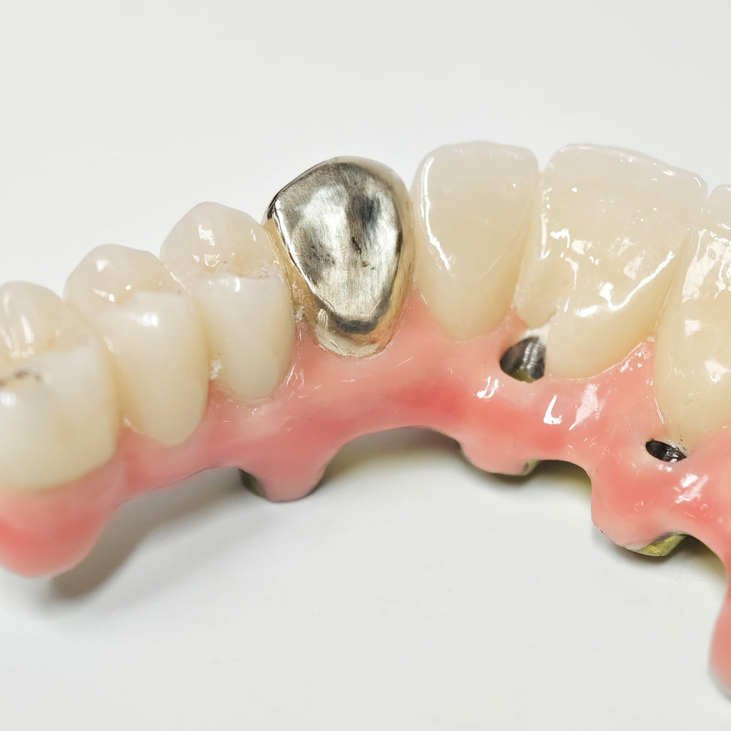 Malo Bridge With Gold-Plated Titanium Framework And A Gold Crown