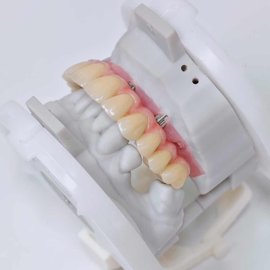 Malo Bridge With Screw-Retained