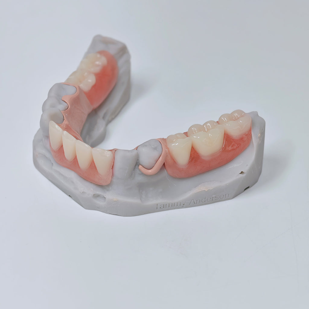 PEEK Framework Denture Metal Framework With Acrylic Denture