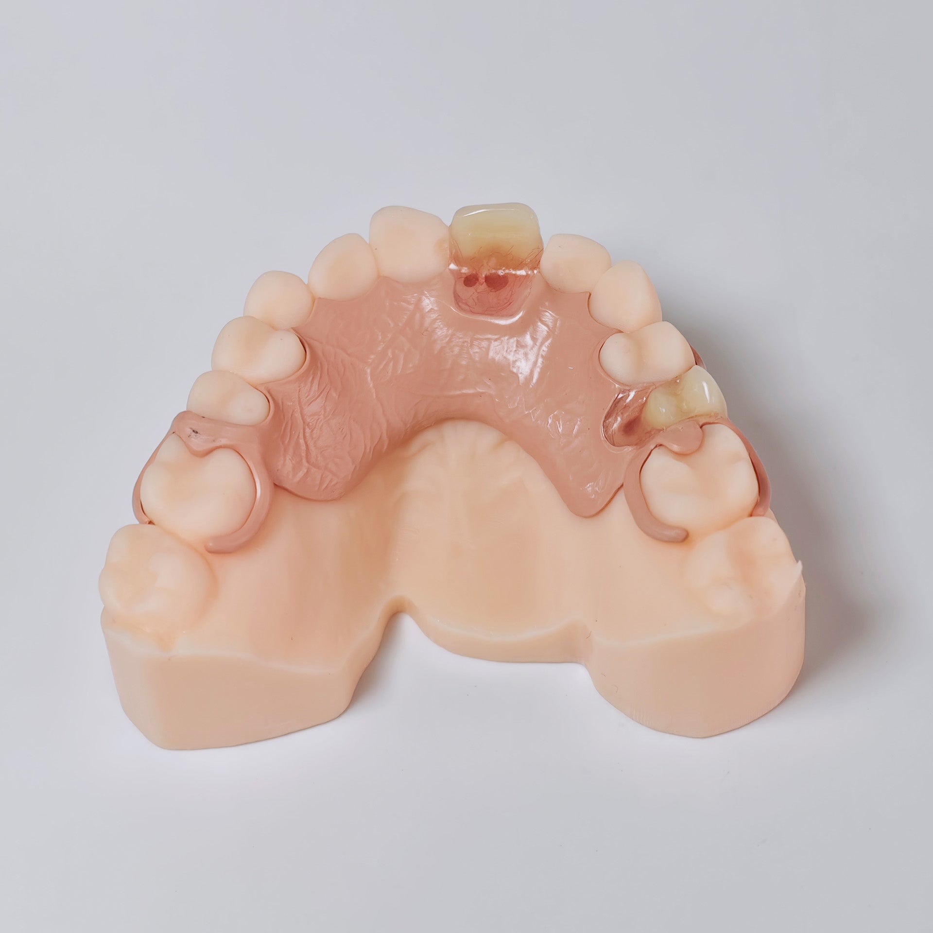 PEEK Framework Denture Metal Framework With Acrylic Denture
