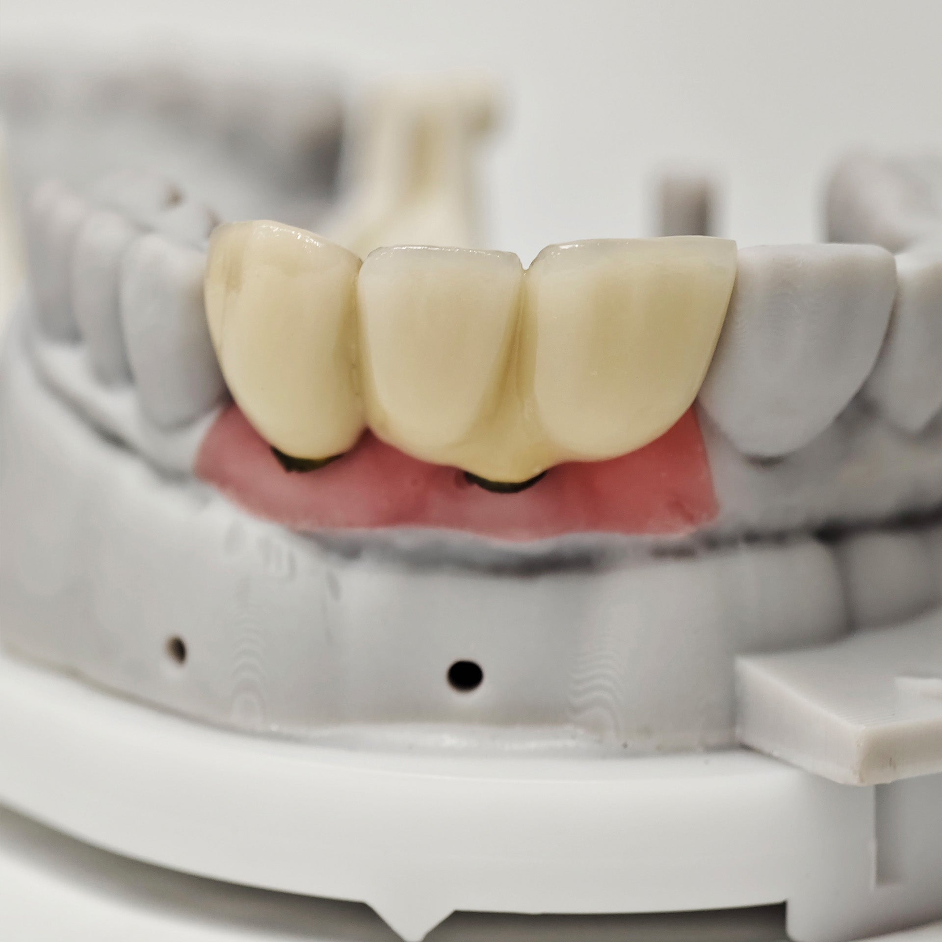 PFM Bridge With Screw-Retained And Implant Seating Guide