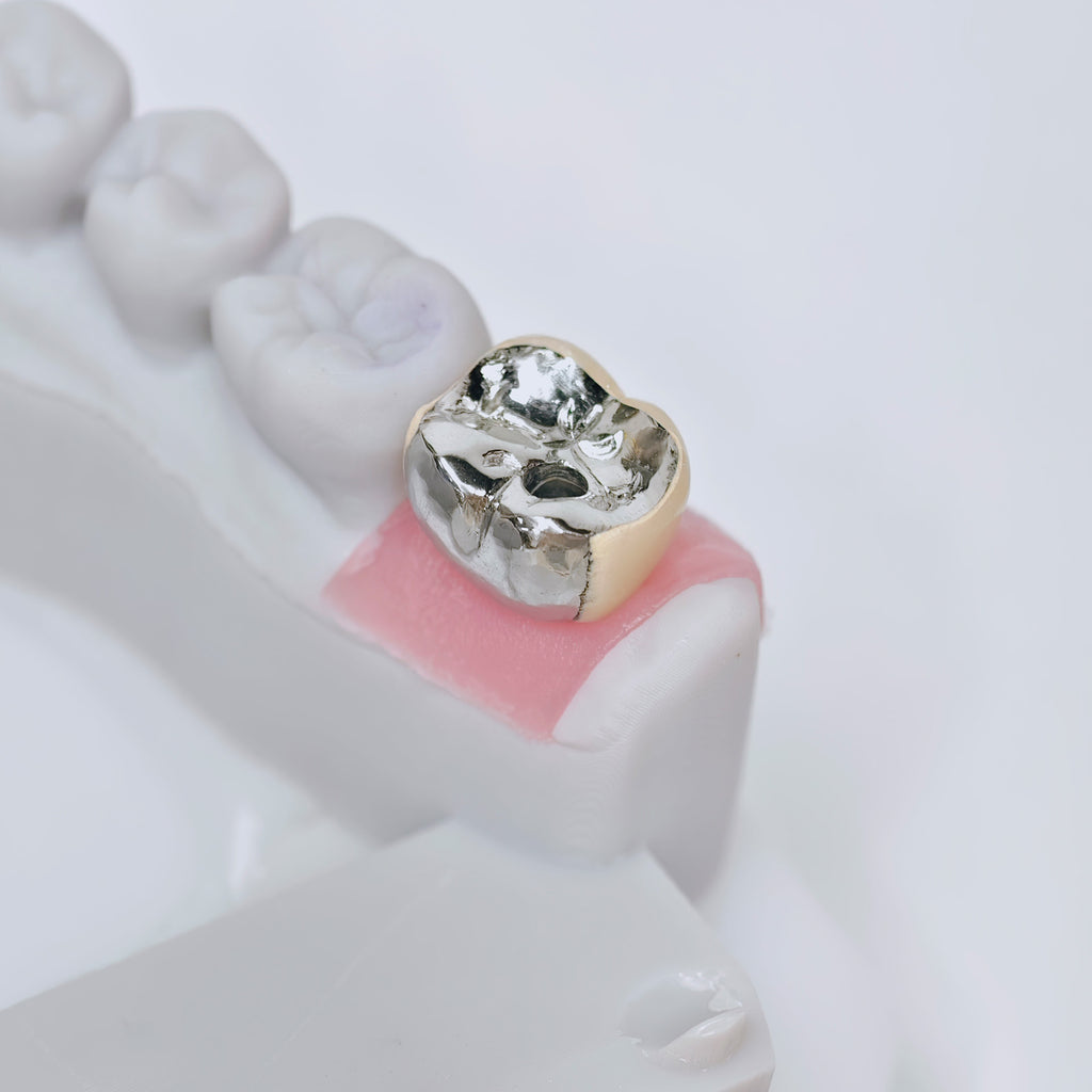 PFM Crown With Screw Retained