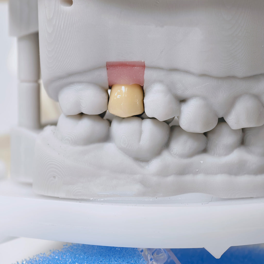 PFM Crown With Screw Retained