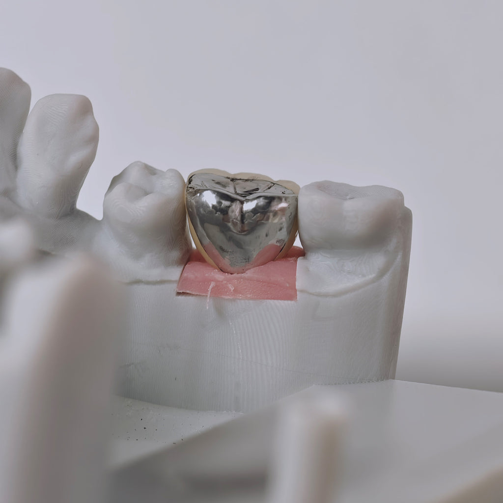 PFM Crown With Screw Retained