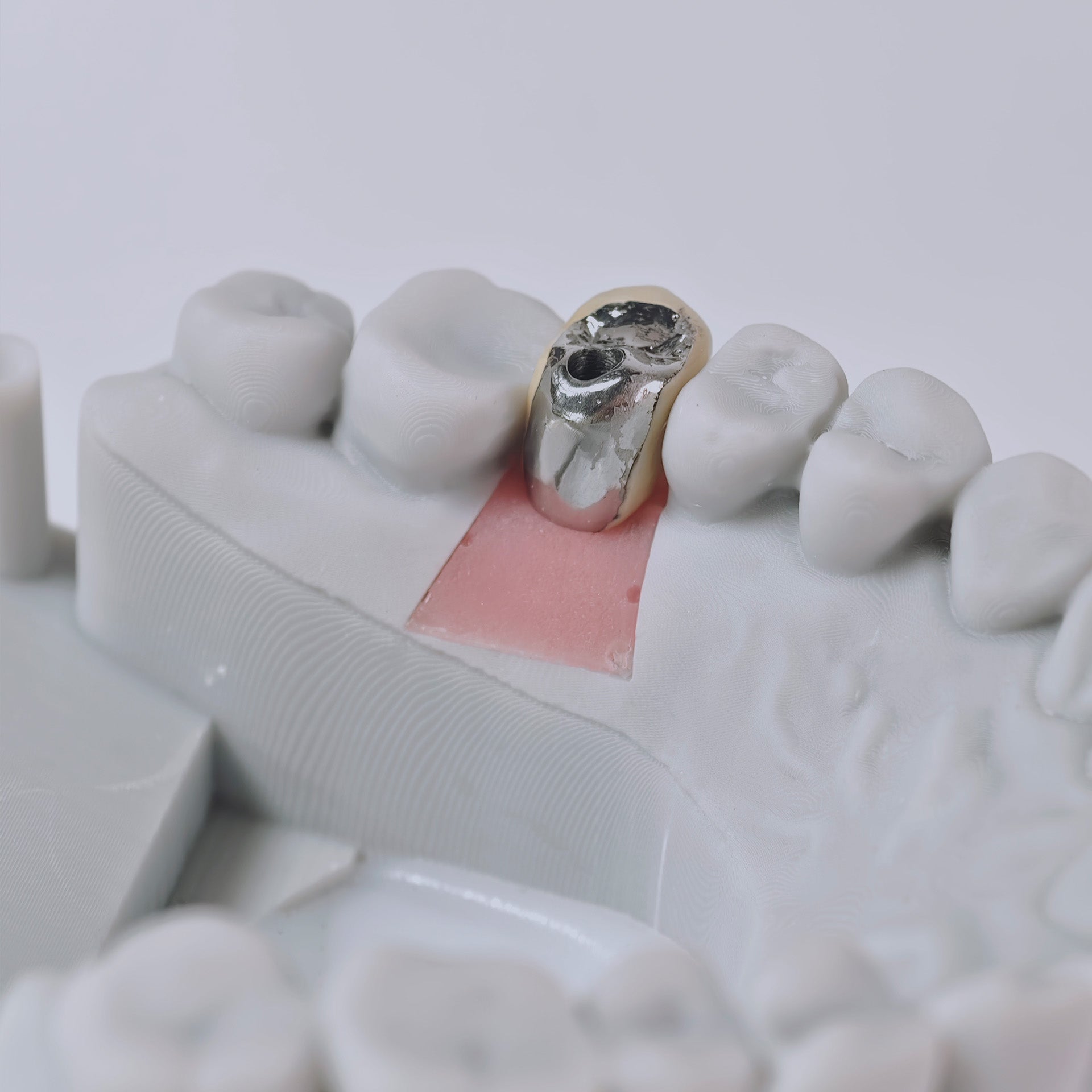 PFM Crown With Screw Retained