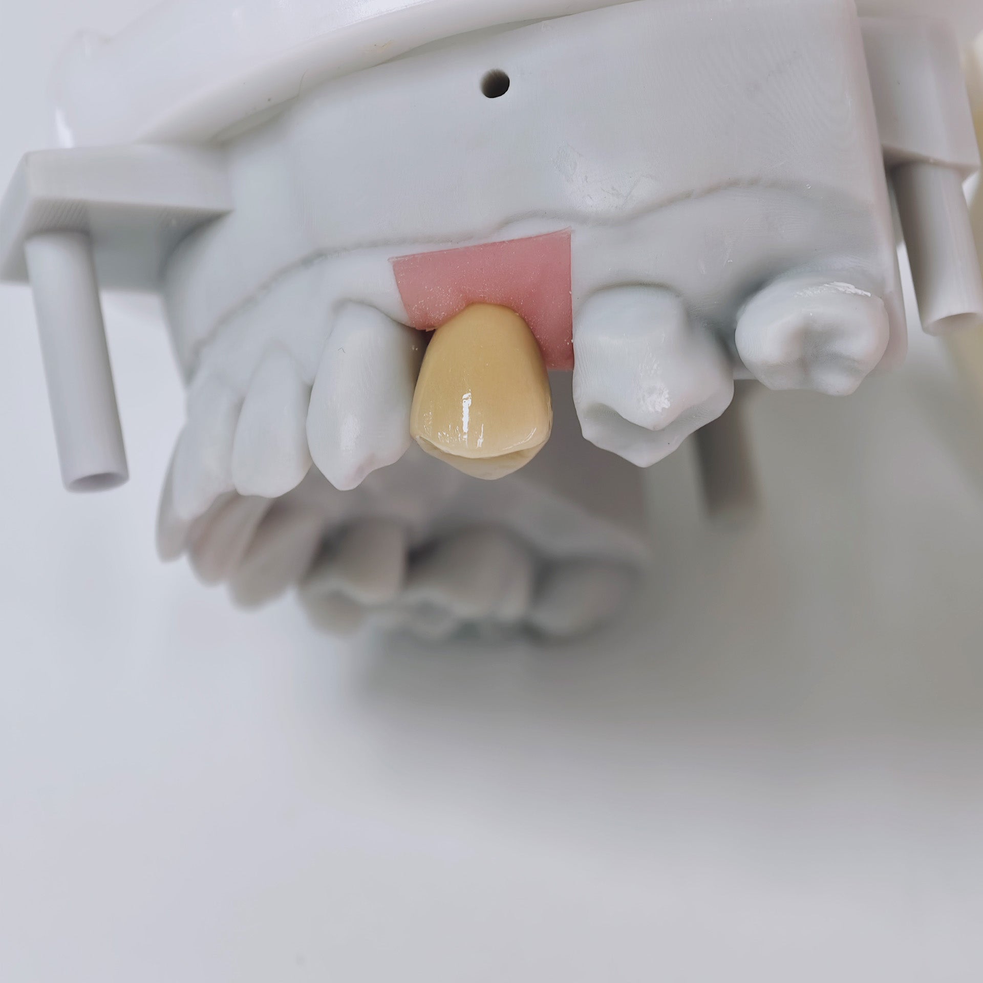 PFM Crown With Screw Retained