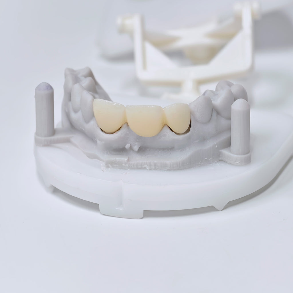 PFZ Dental Bridge – Depth And Aesthetics