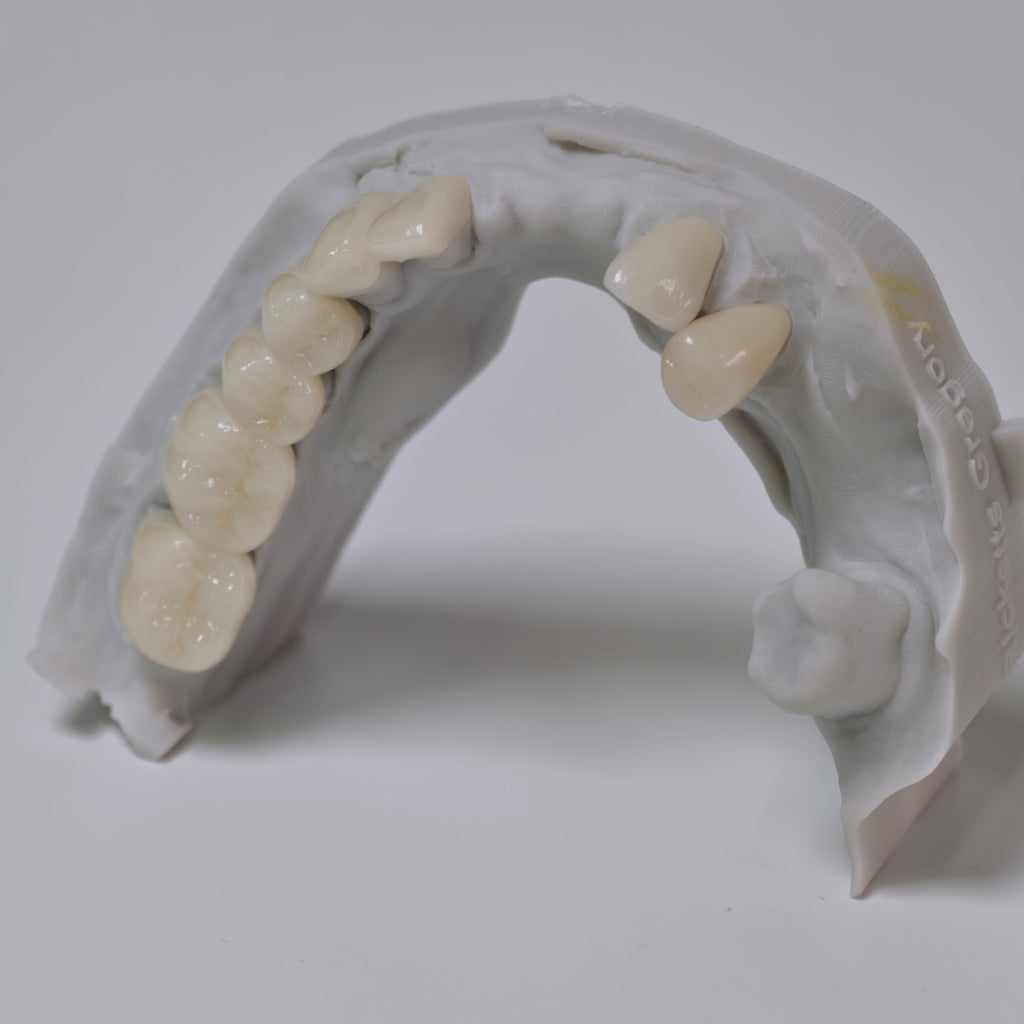 PFZ Porcelain Fused Zirconia Aidite Zirconia