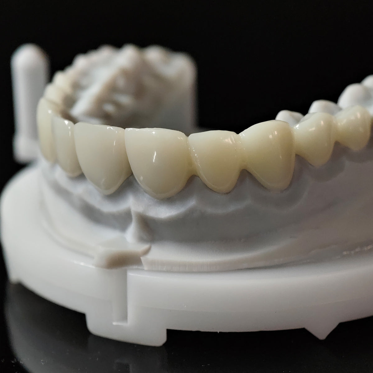 PMMA Bridge Veneer With Cement Retained