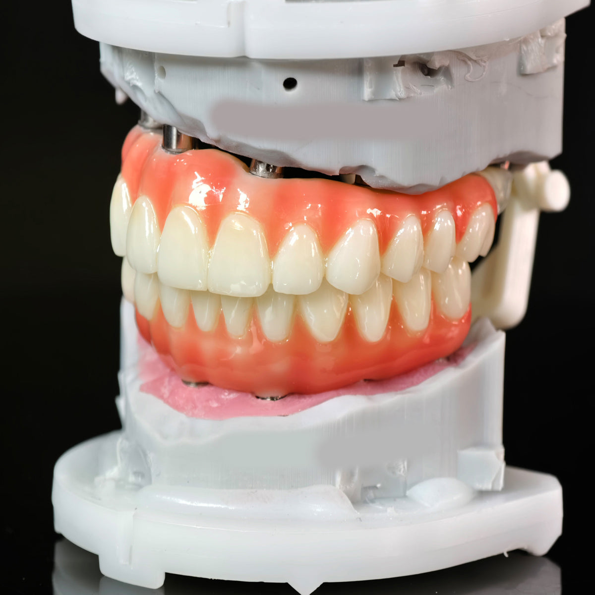 PMMA Bridge With Ti-Base Screw Retained Trying For Full Arch Restoration