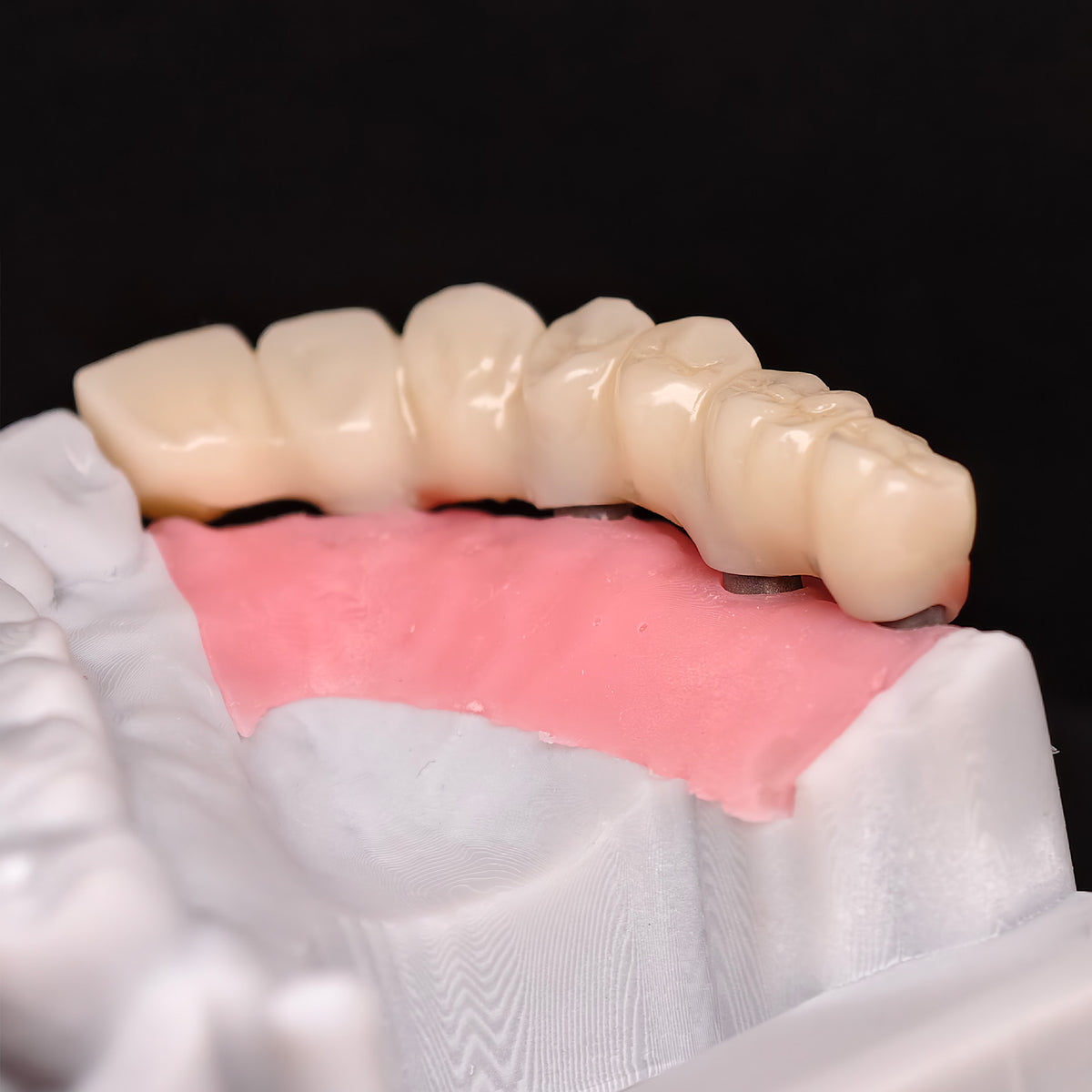 PMMA Bridge With Custom Abutment And Implant Seating Guide