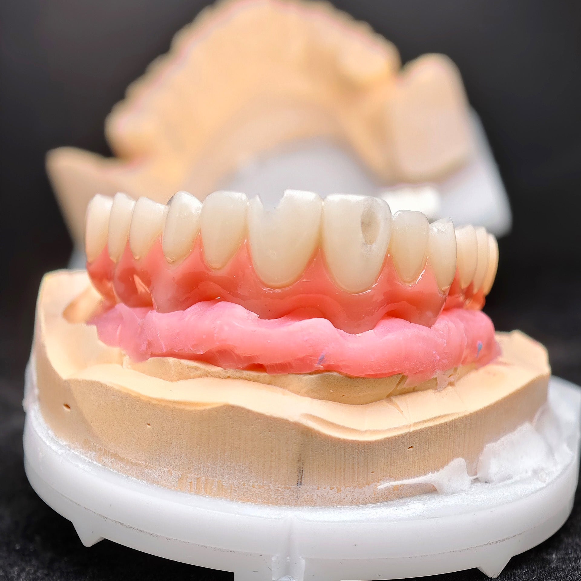 Pmma Bridge With Screw-Retained